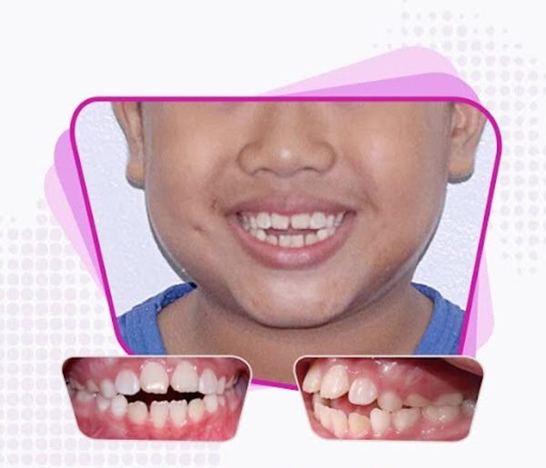 Children with open bites have upper and lower jaws that are far apart.