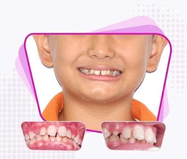 A deep bite causes only the upper jaw to be visible when the child smiles.