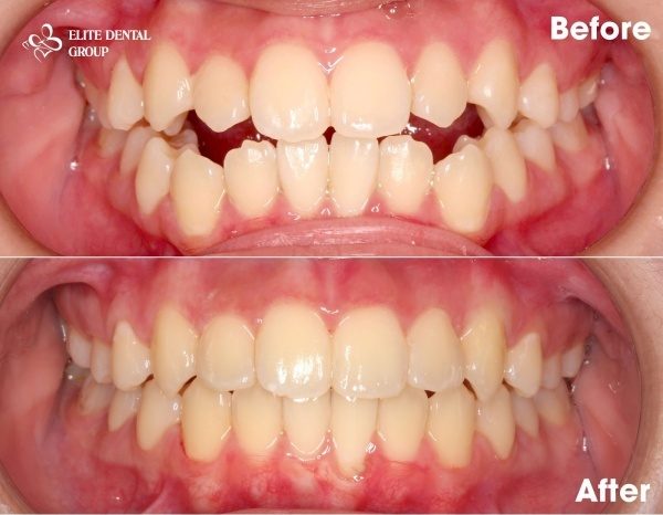 do braces change the face shape?