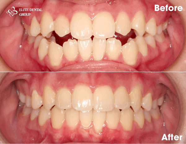 Removable Invisalign braces are effective for treating open bite issues.