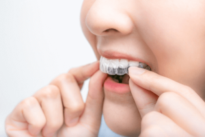 Removable orthodontic appliances provide comfort and convenience during braces treatment.