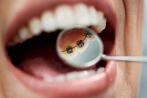 How much do lingual braces cost?