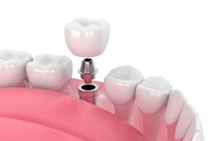 advantages and disadvantages of dental implants