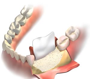 bone grafting in implant