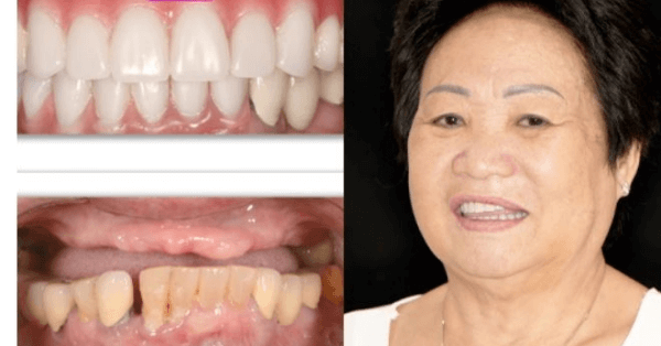 successful dental implant