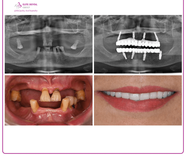 dental implant surgery journey