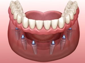 all-on-6 dental implant treatment