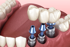 implant post rejection