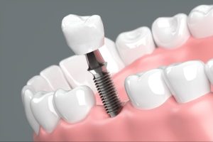 dental implant after tooth extraction