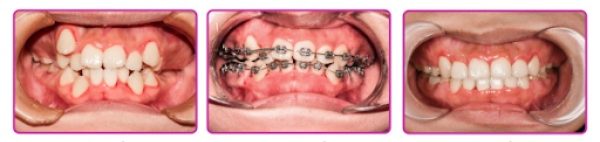 the process of getting metal braces