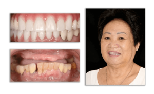 the successful dental implant result made ms. cam y extremely happy