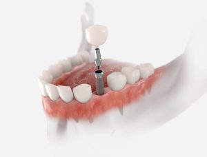 What is an implant abutment?