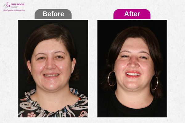 Before & After 