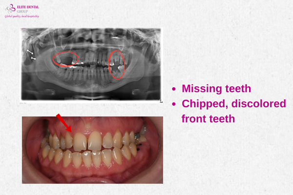 Missing teeth, Chipped, discolored front teeth