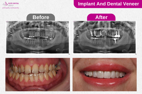 Implant and dental Veneer