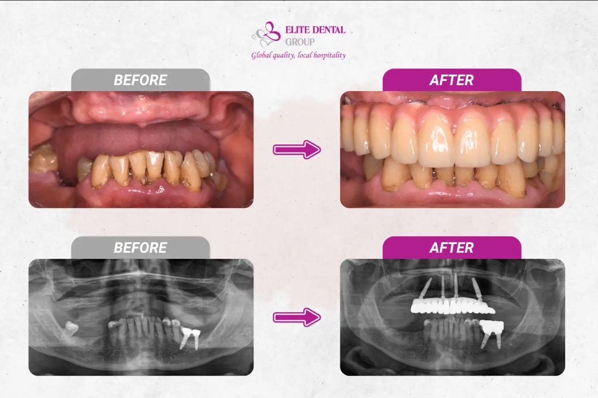 Final restoration after 10 days