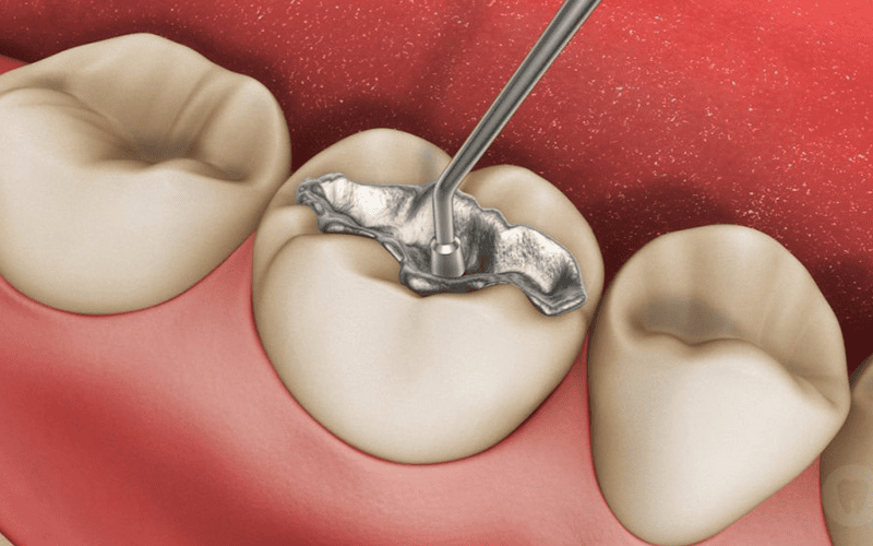 Amalgam filling photo