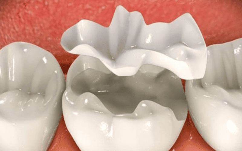 About composite resin fillings