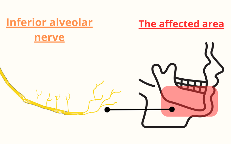Complex wisdom tooth extraction may injure this nerve
