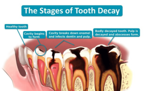 Tooth decay process