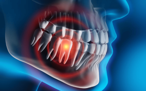 complex wisdom tooth extraction​