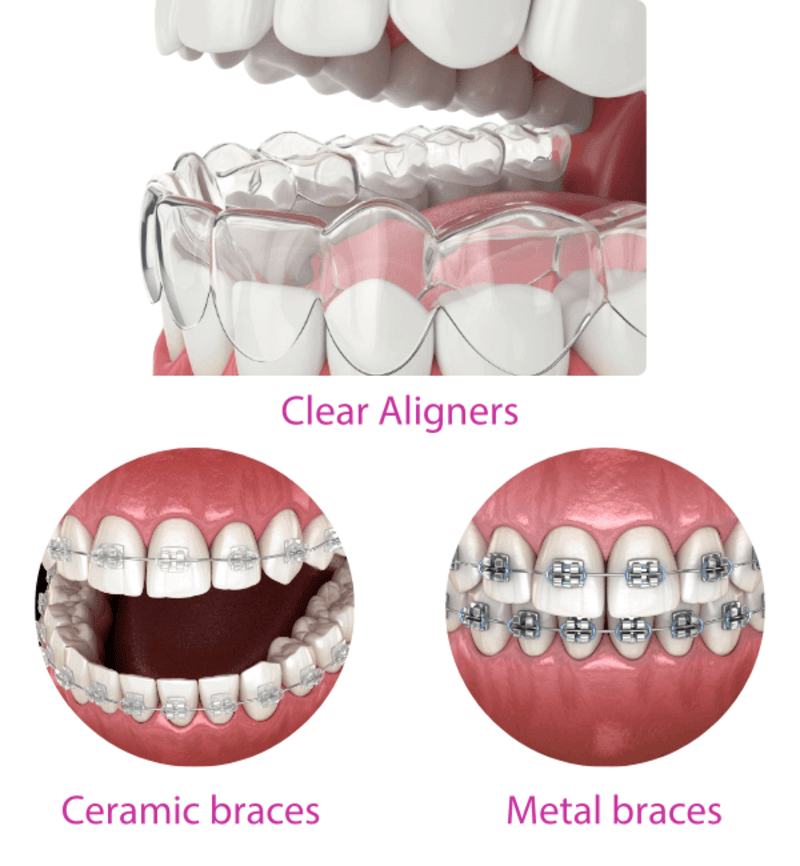 Compare Invisalign braces with braces