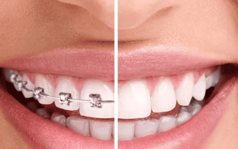 Invisalign braces and conventional braces