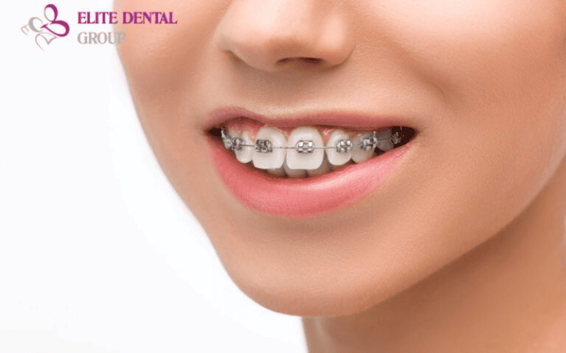 Orthodontic Braces