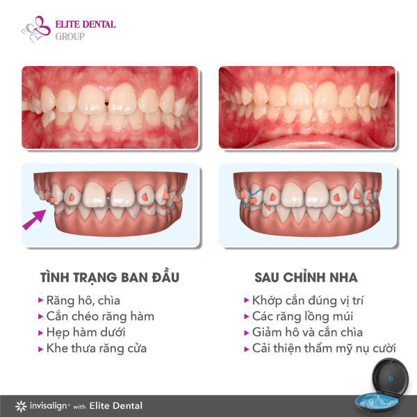 case asymmetrical jaw