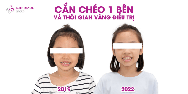 After 3 years of treatment at Elite Dental, the child's crossbite on one side of the jaw has now returned to its correct position, and the balanced face helps the child feel more confident when communicating.