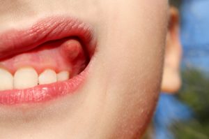 Symptoms of gingivitis in children