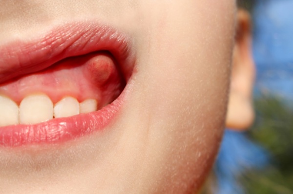 Symptoms of gingivitis in children
