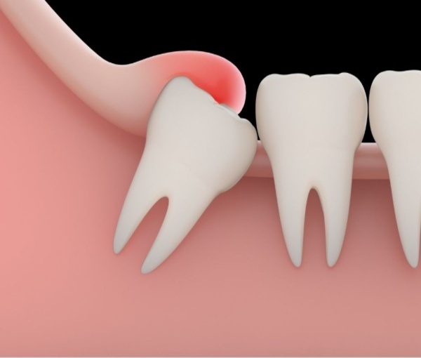 Wisdom teeth eruption