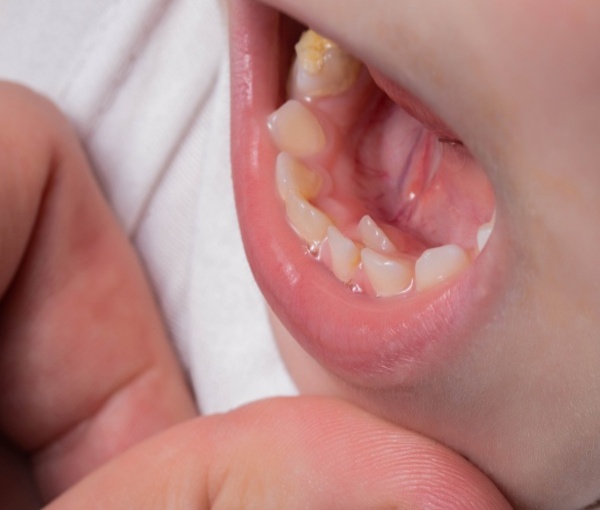 The child's eating habits make it difficult for the milk teeth to loosen
