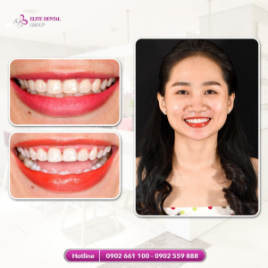 How many steps does the teeth whitening process include?