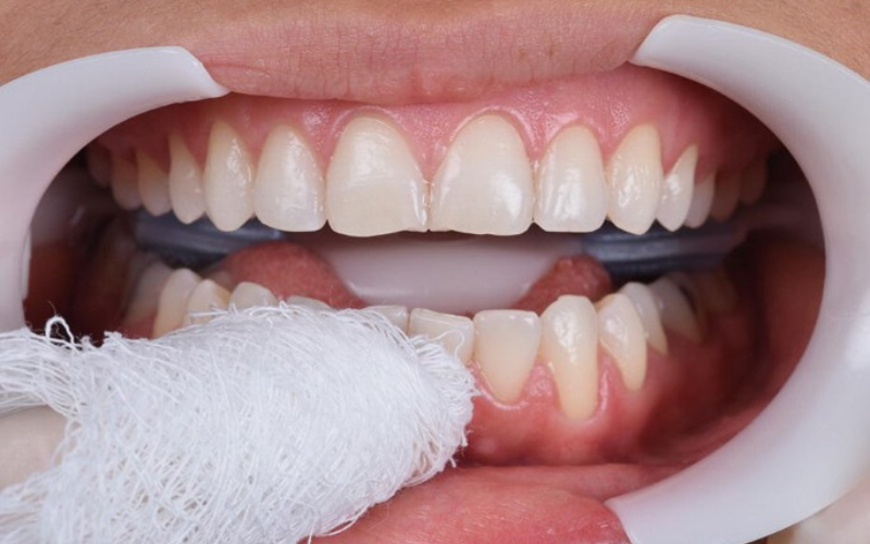 To keep your lips, cheeks, and tongue away, use gauze, cotton rolls, and lip retractor