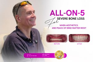 full-arch dental implant journey at Elite Dental