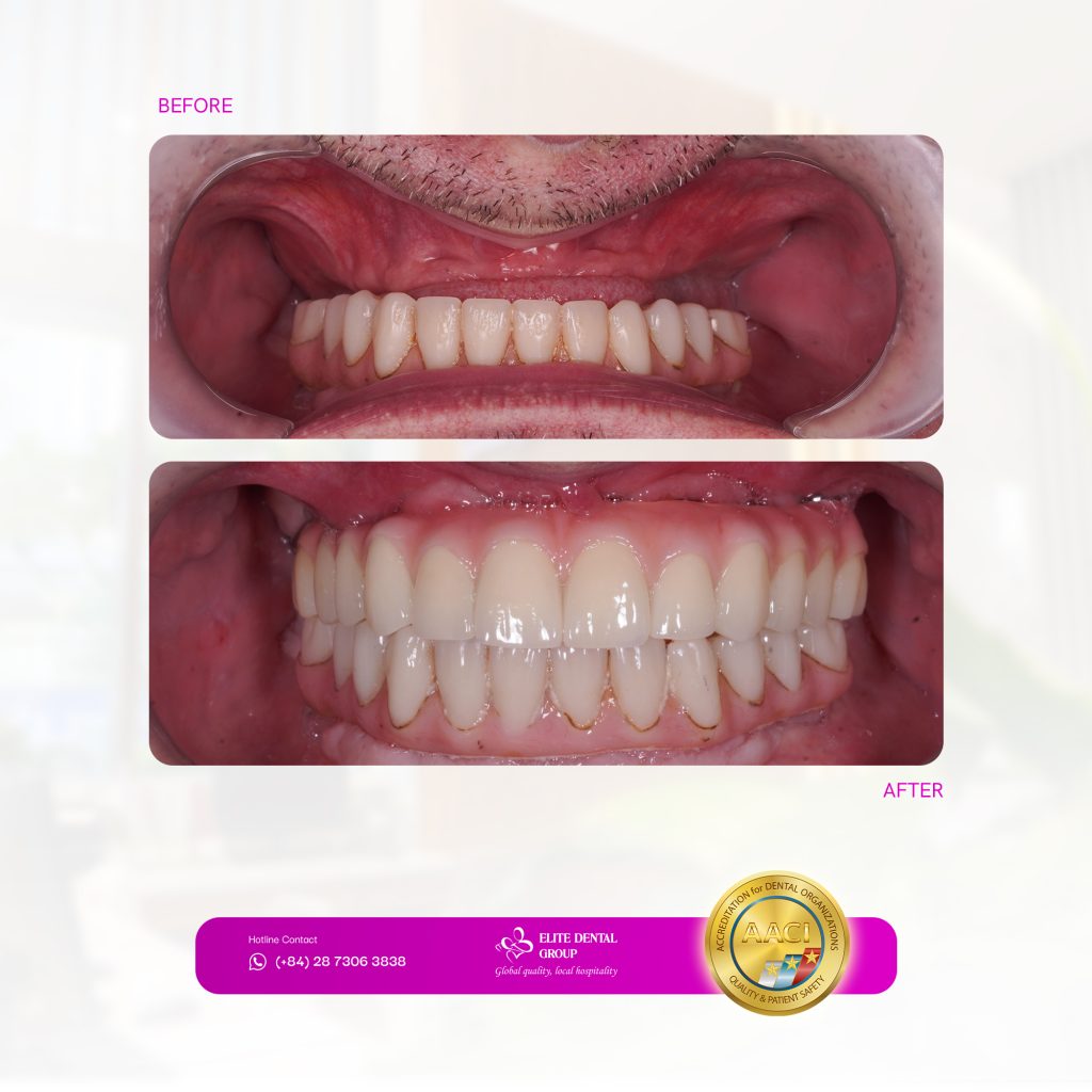 Before-and-after images of the final full-arch restoration on All-on-5 Implants