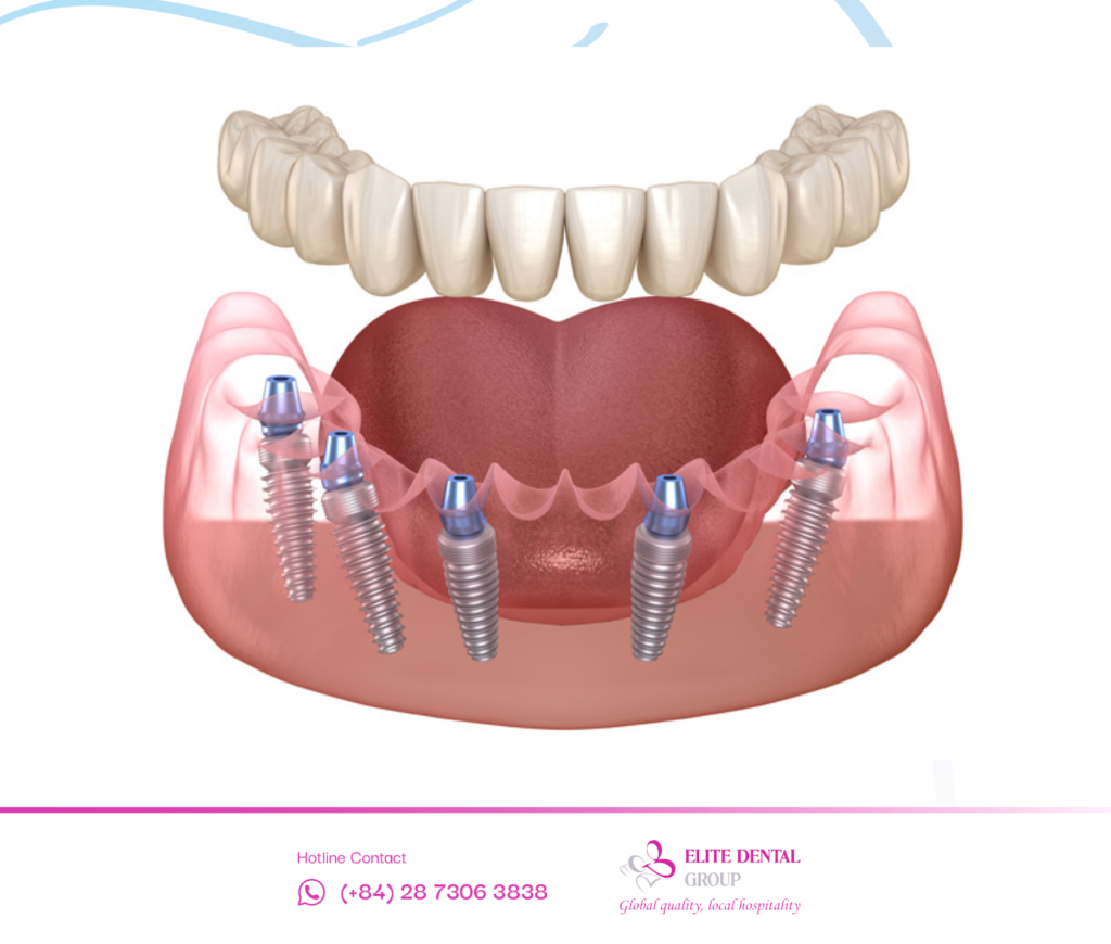 Illustration of All-on-5 full-arch dental implants 