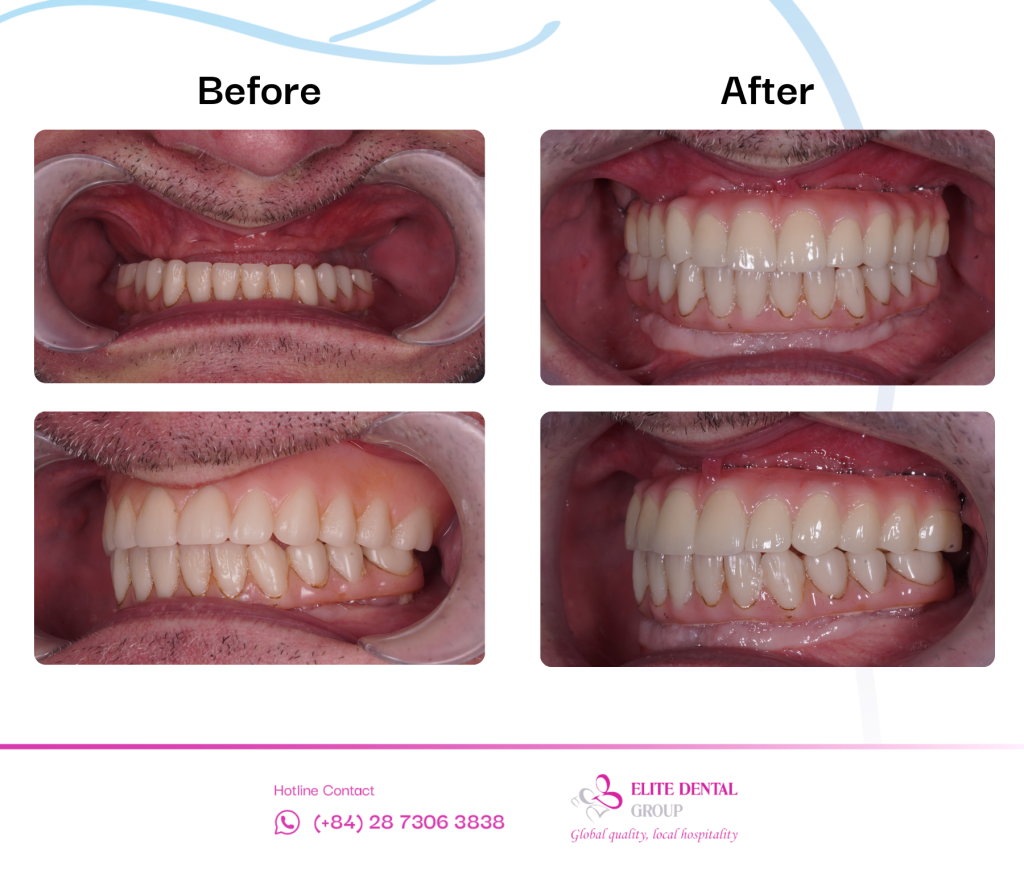 Final fixed bridge and personalized smile design for full-arch implants