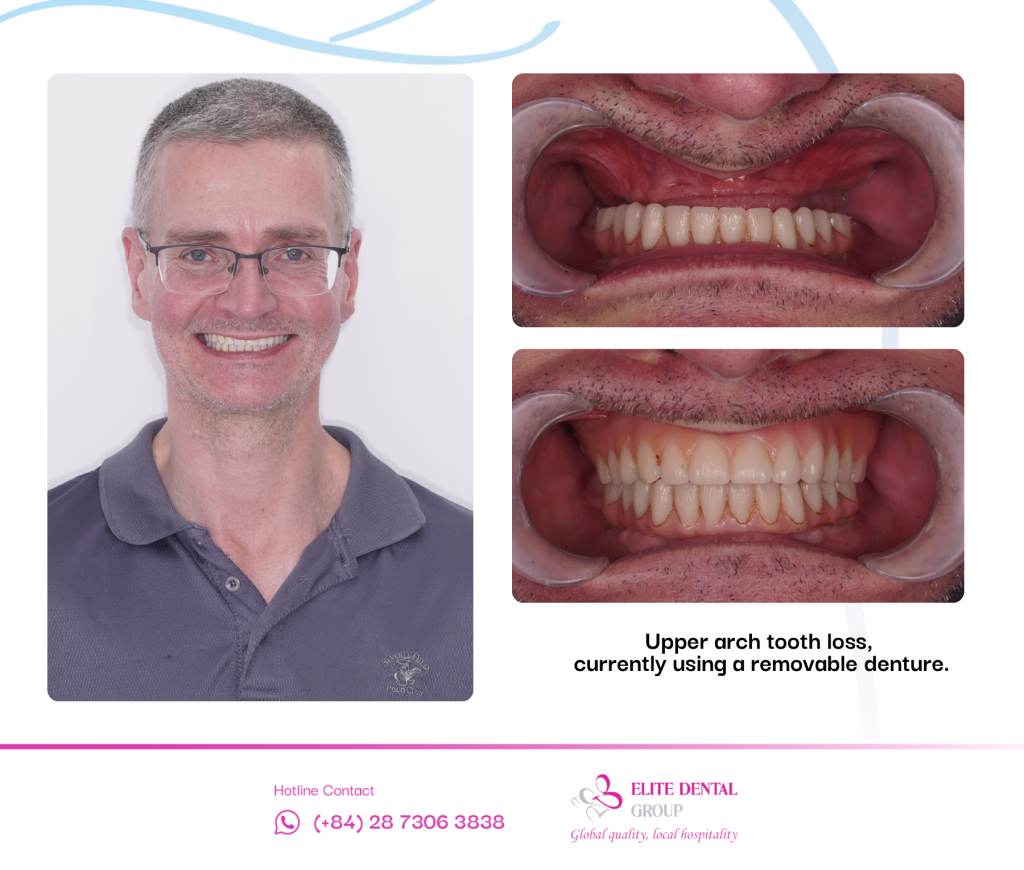 dental condition before dental implant treatment at Elite Dental