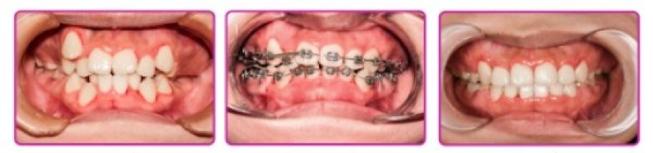 A successful case of metal braces at Elite Dental, resulting in a healthy and radiant smile.