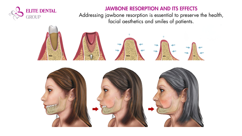 Images of tooth socket resorption over time