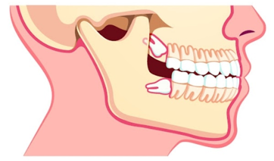 Wisdom teeth positioned horizontally are oriented at an angle of 45-90 degrees relative to the seventh tooth.