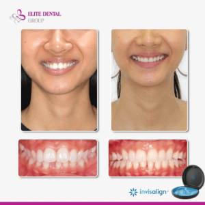 Clear aligners (Invisalign) can help reposition the jaw and teeth, enhancing facial symmetry.