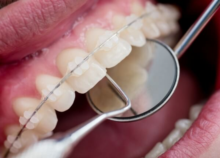 Choose a reputable orthodontic center with skilled and gentle orthodontists to minimize discomfort during treatment.