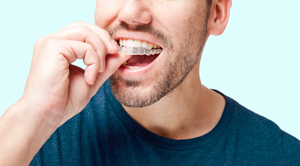 Orthodontic treatment is the optimal solution for cases of jaw deviation caused by crooked or crowded teeth.