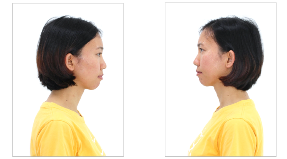 Image of the face of a customer with a receding chin (short chin) that makes the face unbalanced.