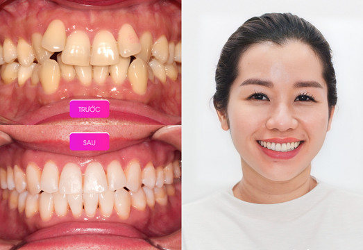 Răng của chị Nguyệt Nga trước và sau khi điều trị tại Elite Dental