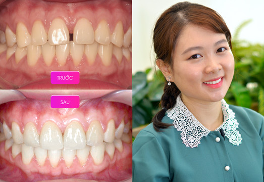 Răng của Thanh Trúc trước và sau khi điều trị tại Elite Dental